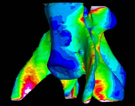 FEA model of Bone Breaking
